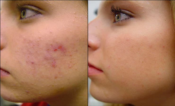 acne pimples