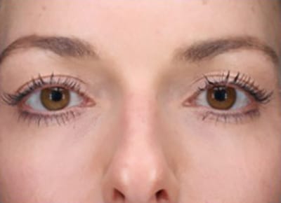 total eye after 2