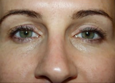total eye before
