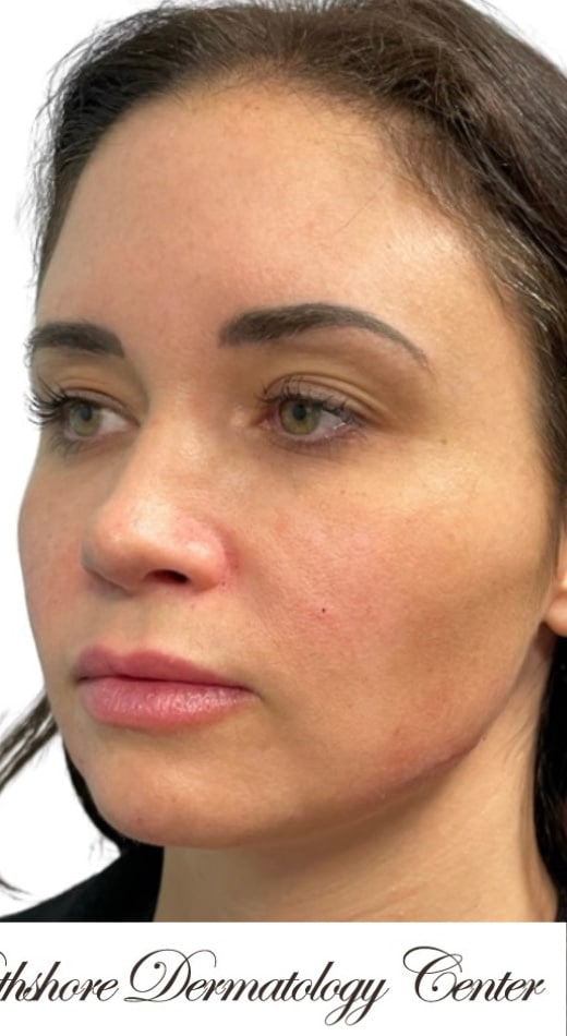 After Image: Full Facial Treatment - left-front-oblique