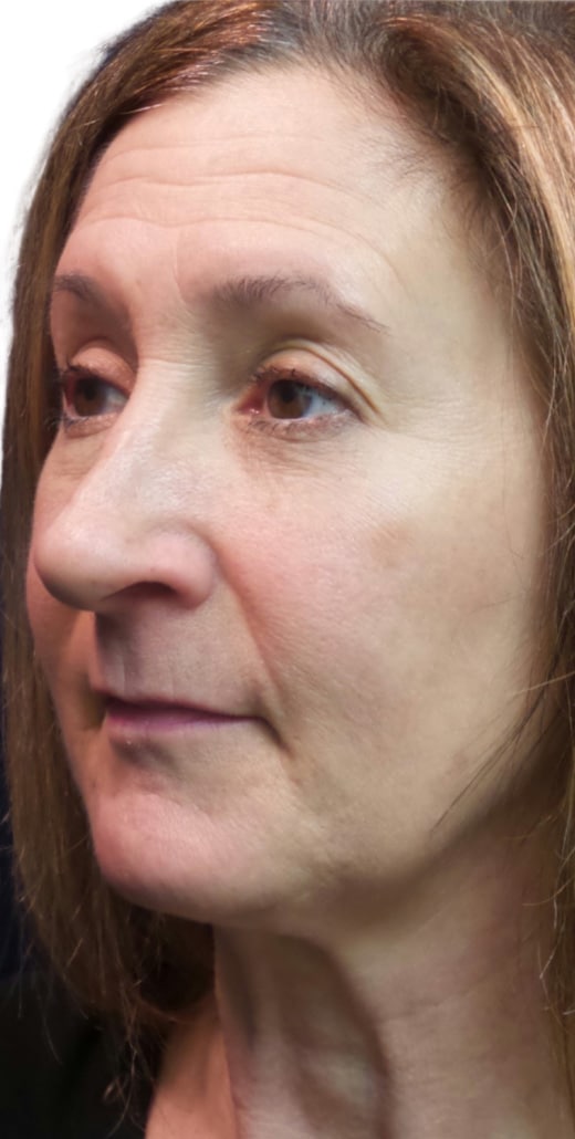 Before Image: Kysse and Contour Package - left-front-oblique