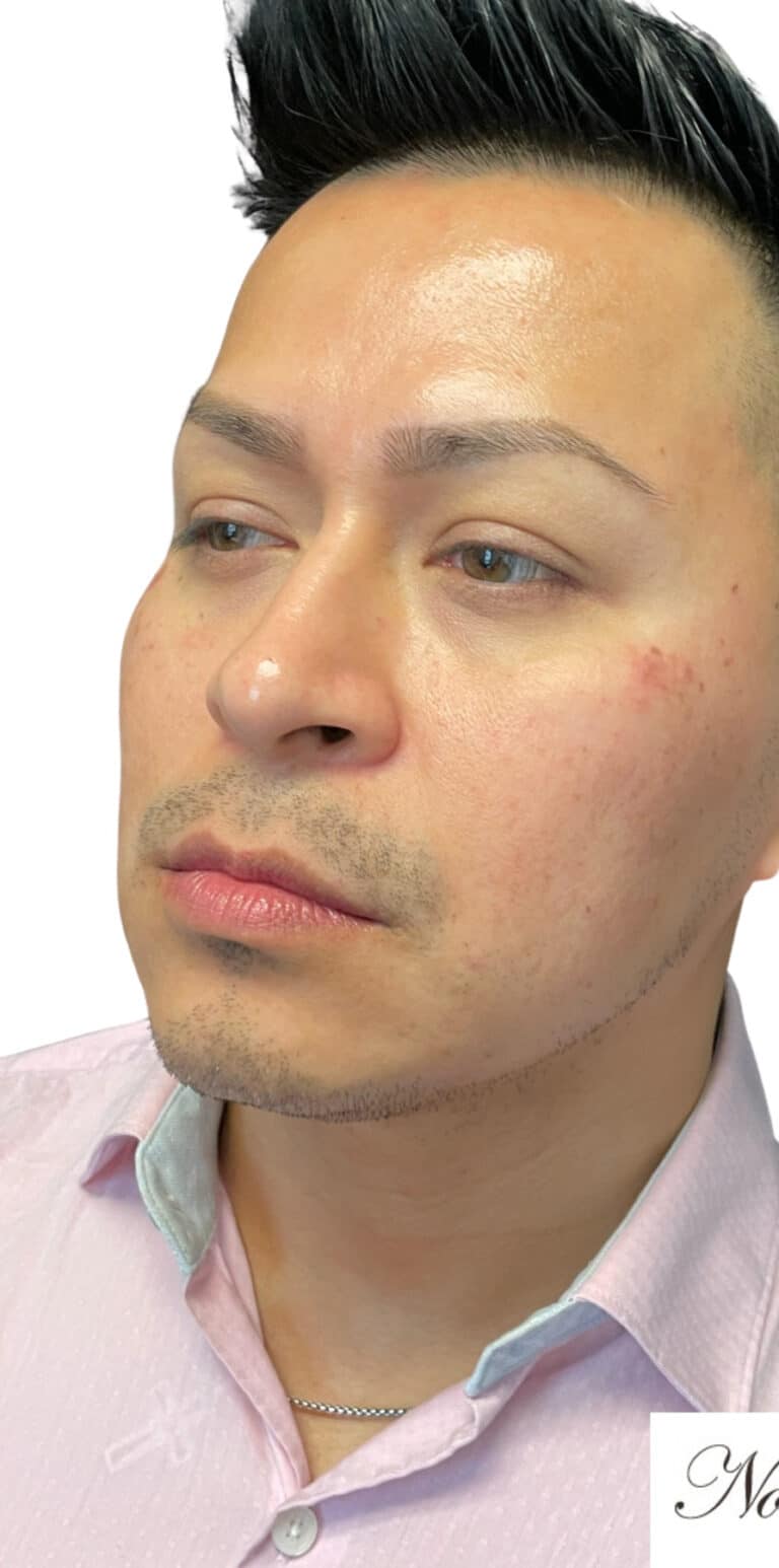 Before Image: Kysse and Contour Package - left-front-oblique