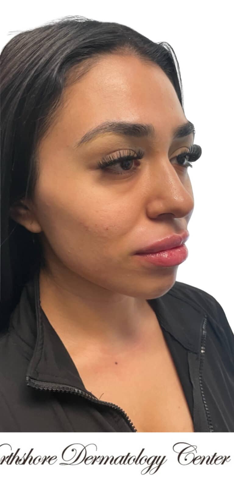 After Image: Kysse and Contour Package - right-front-oblique