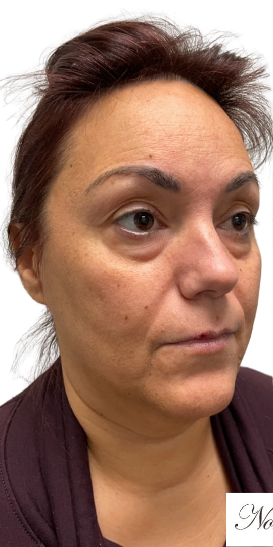Before Image: The Lux Package - right-front-oblique