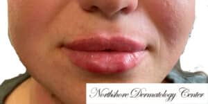 After Image: Lip Filler