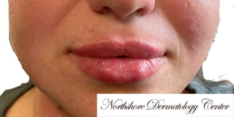 After Image: Lip Filler - front