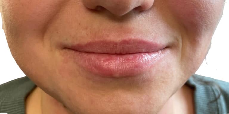 Before Image: Lip Filler - front