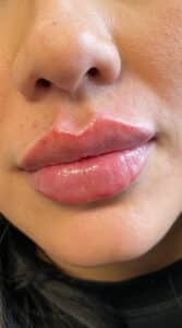 After Image: Lip Filler