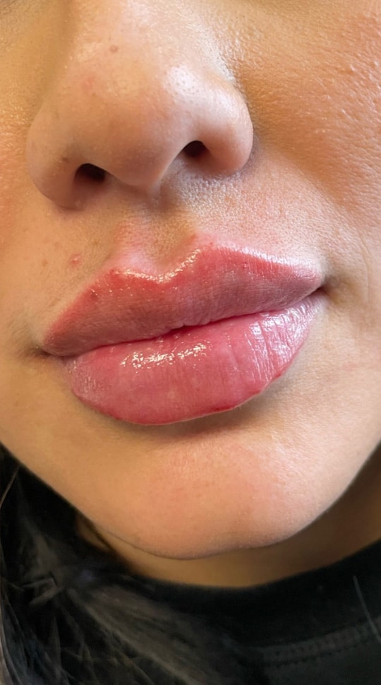 After Image: Lip Filler - right-front-oblique