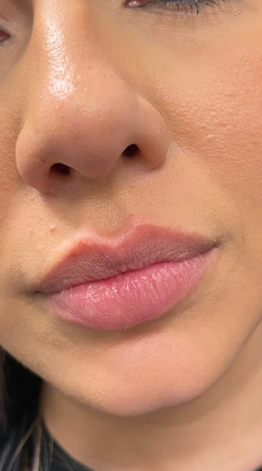 Before Image: Lip Filler - right-front-oblique