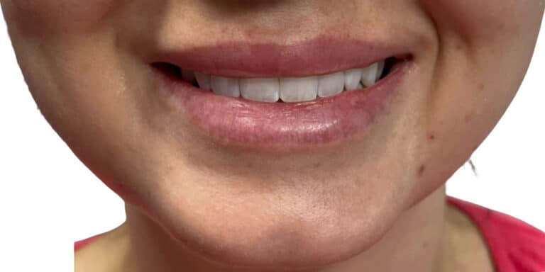 Before Image: Lip Filler - front