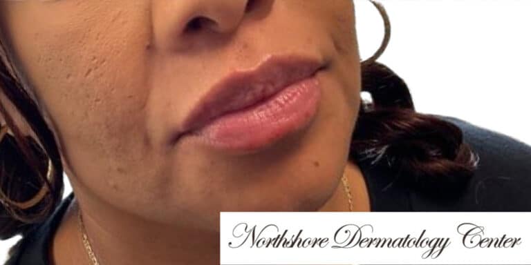 After Image: Lip Filler - right-front-oblique