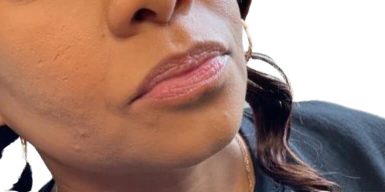 Before Image: Lip Filler - right-front-oblique