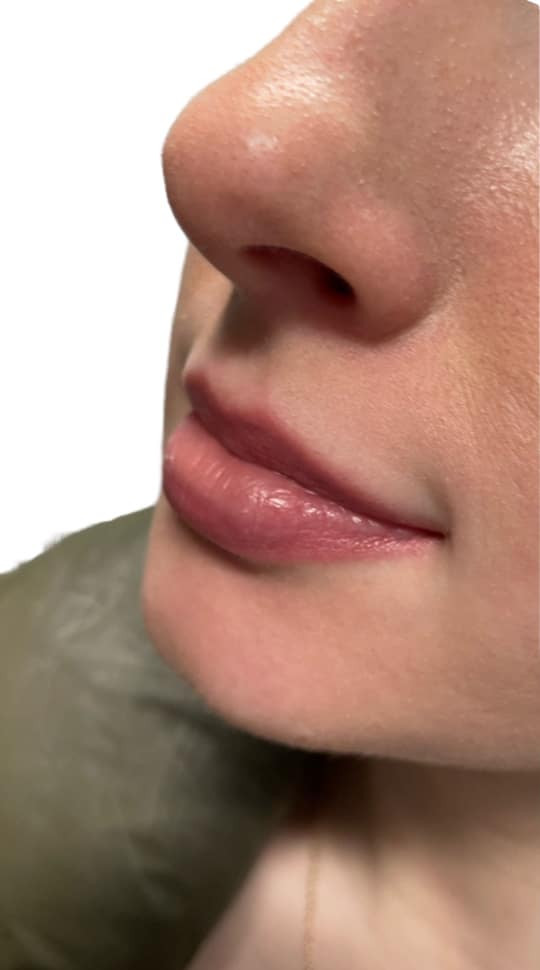Before Image: Lip Filler - left-front-oblique